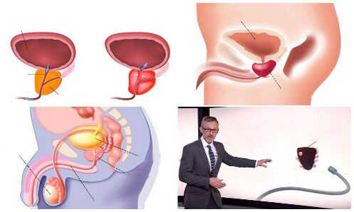 healthy and sick prostate